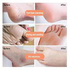 Cracked Heel Cream Feet Remove Dead Skin Soften Foot Anti Drying Cracked Heal Callus Repair Cream Foot Care Pedicure Tools 2020 Buy From 0 85 On Joom E Commerce Platform
