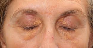 Image result for xanthelasma of eyelid