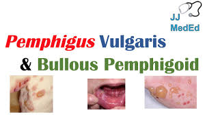 Image result for Pemphigus