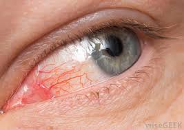 Résultat de recherche d'images pour "eye infection"