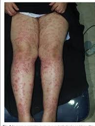 Possible laser hair removal side effects include: Purpura Induced By Laser Hair Removal A Case Report Semantic Scholar
