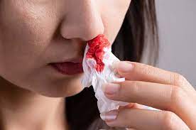 Sakit kepala sebelah kiri bisa disebabkan gaya hidup tak sehat sampai penyakit tertentu. Mimisan Disertai Sakit Kepala Ketahui Penyebabnya