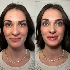 L I P • F L I P • W I T H • F I L L E R Have you been