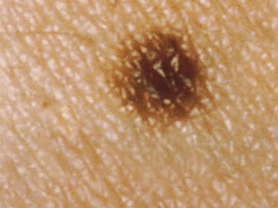 Moles: Types, causes, treatment, and diagnosis