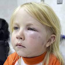 Anaphylaxis In Babies And Children Babycenter
