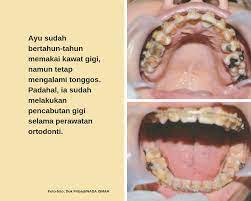 Maybe you would like to learn more about one of these? Jeo Pasang Kawat Gigi Jangan Cuma Asal Mau Bikin Rapi