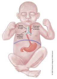 About 8,500 women are diagnosed with womb cancer in the uk each year, with around five out of every 100 cancers diagnosed in sign up to our newsletter to get more articles like this delivered straight to your inbox. Tracheal Esophageal Fistula And Esophageal Atresia Children S Wisconsin
