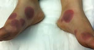 Image result for Fixed Drug Eruption