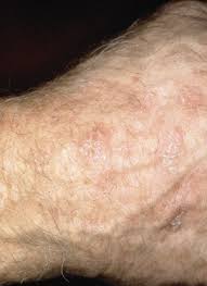 Bowed calves are very shapely, but large, turning towards the outside of the body. Early Detection And Treatment Of Skin Cancer American Family Physician