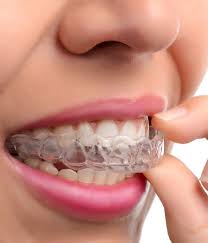 Braces are effective for treating most overbite problems. How Long Does It Take To Adjust To Invisalign Boston Ma