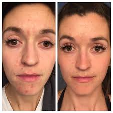 Dry skin face wash recommendations for acne prone skin