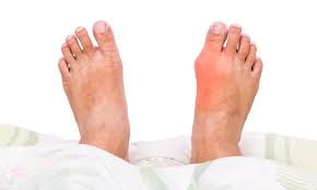 Image result for gout symptoms toe