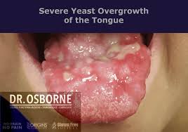 Go to urgent care or your doctor. Is It Gluten A Yeast Overgrowth Or Both Gluten Free Society