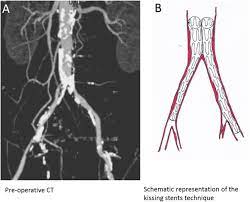 Ft15 Endovascular Vs Open Treatment Of Severe Aortoiliac Occlusive Disease Outcomes Of Kissing Self Expanding Covered Stent For Reconstruction Of The Aortic Bifurcation Journal Of Vascular Surgery
