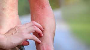 Image result for Skin Infection