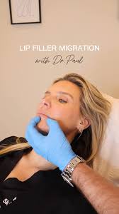 How to spot Lip Filler Migration with Dr.Paul 🔎 , Noticing a puffy upper  lip or blurred lip border? These could be signs of filler migration — a  common issue after years of topping up without ...