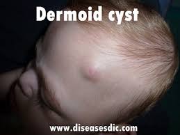 A google ingyenes szolgáltatása azonnal lefordítja a szavakat, kifejezéseket és weboldalakat a magyar és több mint 100 további nyelv kombinációjában. Dermoid Cyst Causes Complications And Treatment