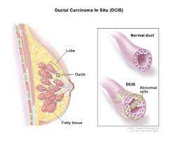 Find out what this type of carcinoma is, how the different types are treated & more. Definition Of Ductal Carcinoma In Situ Nci Dictionary Of Cancer Terms National Cancer Institute