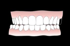 There are several reasons why some people's teeth grow in crooked, overlapping, or twisted. What Is A Crossbite And How To Fix It Newmouth