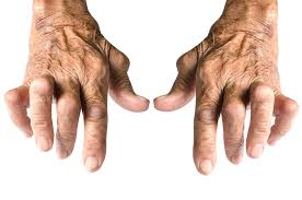 Image result for what arthritis
