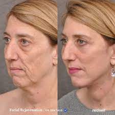 How long for botox to work in forehead. How Long Does Botox Take To Work Arxiusarquitectura