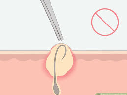 You can find treatment for legs, treatment for face, on neck, on men. How To Get Rid Of Ingrown Pubic Hair With Pictures Wikihow