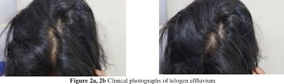 Supplementing with iron and other nutrients can not only prevent further hair loss but can also help regrow hair. Dermoscopic Study Of Hair Loss In Females And Its Correlation With Serum Ferritin Levels Semantic Scholar