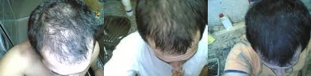 F D A Onayli Sac Cikaran Ilac Minoxidil