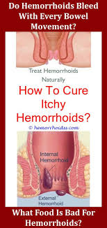 How Long Do Hemorrhoids Last After Giving Birth Hemorrhoids Bleeding Hemorrhoids Getting Rid Of Hemorrhoids