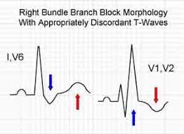 Image result for Right Bundle Branch Block