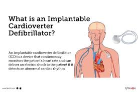 Image result for Internal Cardiac Defibrillator