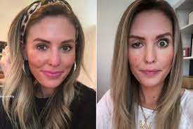 Influencer Candidly Reveals What Happens When Botox Goes Wrong People Com