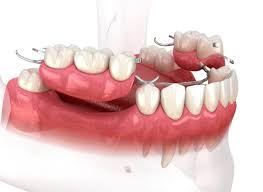 Image result for dentures
