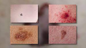 Skin cancer may appear in a variety of ways. 3 Ways To Spot Early Signs Of Skin Cancer Wikihow