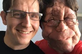 How man with facial deformity became an actor 'by accident'