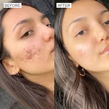 Best Acne Treatment with Salicylic Acid