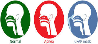 Sleep apnea can be treated through the use of this equipment. Pros And Cons Of Cpap Masks