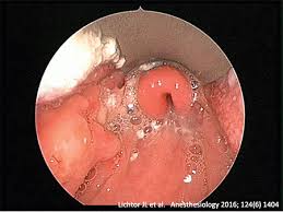 Image result for Epiglottitis