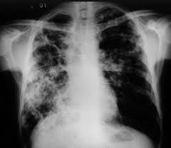 V české republice se pravidelné očkování v současné době týká těchto nemocí (vyhláška 299/2010 sb.): Tbc V Cr Ubyva I Bez Plosneho Ockovani Vliv Maji Izolace A Lecba Aktuality Zpravodajstvi Florence Odborny Casopis Pro Osetrovatelstvi A Ostatni Zdravotnicke Profese