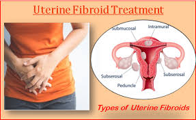 Uterine fibroids are a common type of noncancerous tumor that can grow in and on your uterus. Classification Of Non Cancerous Fibroids And Cost Effective Treatment In India Top Surgeons In India In Ties With Indian Medguru Brings You No 1 Affordable Low Cost Medical Treatment