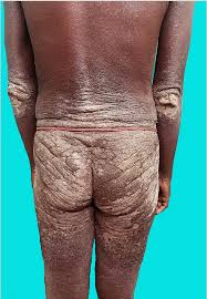 Image result for scabies on genitals