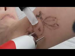Opening hours for tattoo removal in houston, tx. Houston Laser Tattoo Removal Ruby Duality Laser New Look