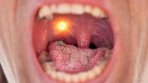 Bitter Taste In My Mouth After Waking Up Bitter Taste In Mouth When I Cough I Have A Bitter Taste In My Practo Consult