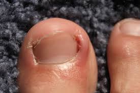 Image result for Akutní zánět nehtového lůžka