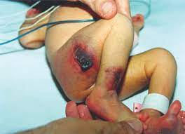 Protein c is a natural substance in the blood that controls clotting. Five Day Old Newborn With Homozygous Protein C Deficiency And Purpura Download Scientific Diagram