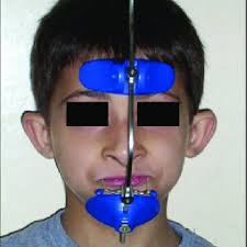 PDF) Correction of skeletal Class III in a growing male patient by reverse  pull facemask