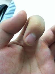 Black lines on nails are common up to a certain degree and most of the time it is harmless. Black Line Under Fingernail Health