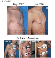 Image result for Pectus Excavatum