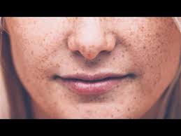 Skin Cancer and Melanoma: New Screening Guidelines