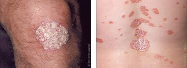 Image result for psoriasis